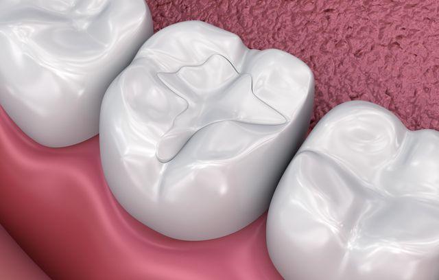 Fillings north-edmonton