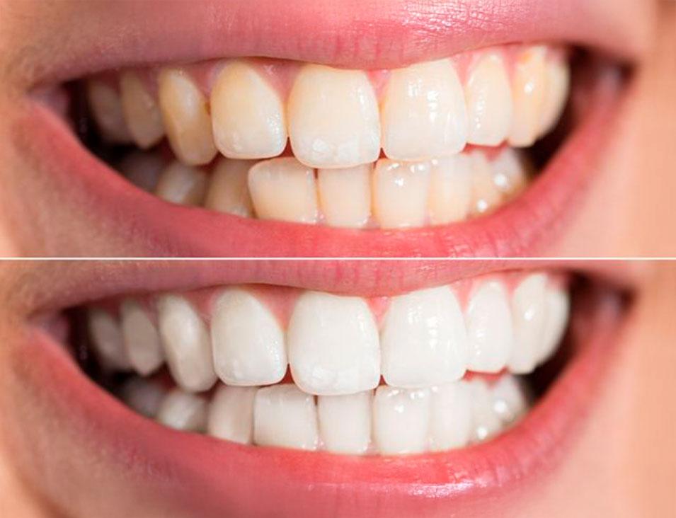 Whitening-north-edmonton