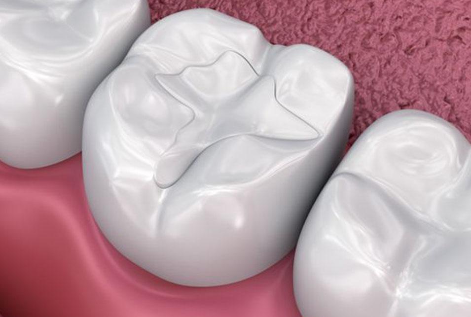 Fillings north-edmonton