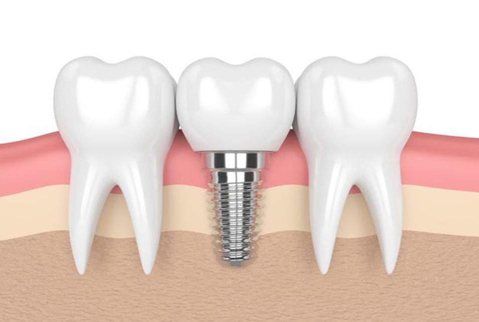 Implants north-edmonton