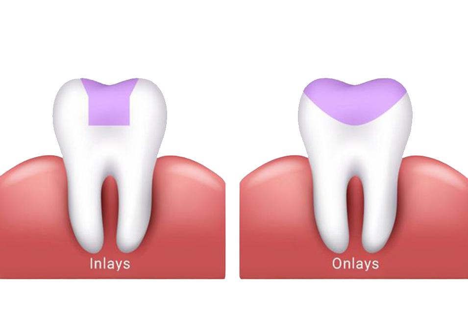 InlaysOnlays