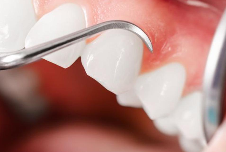 Periodontal Maintenance north-edmonton