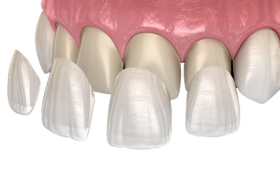 Veneers-north-edmonton