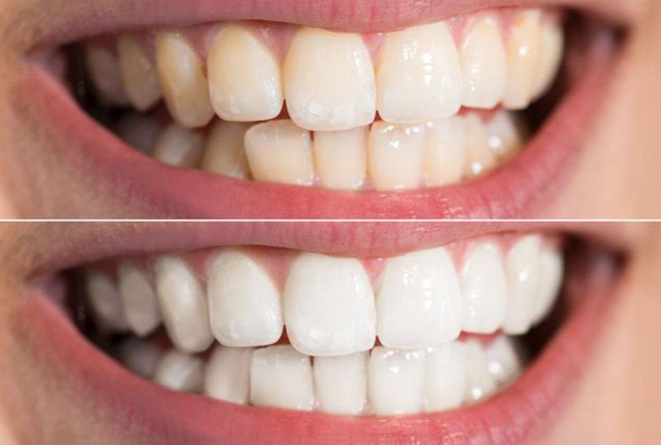 Whitening north-edmonton