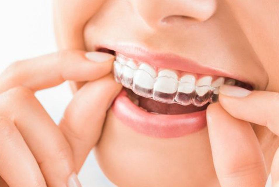 invisalign-north-edmonton